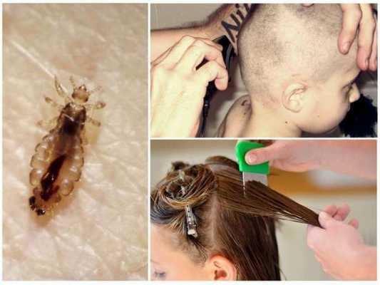 МЕТОДЫ ИЗБАВЛЕНИЯ ОТ ВШЕЙ