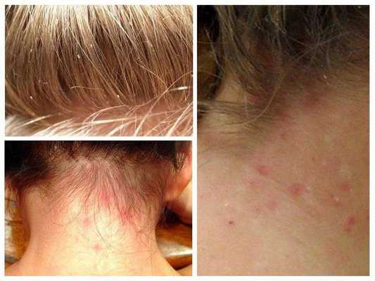 Головные вши у ребенка