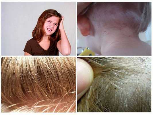 Чем опасны вши у детей