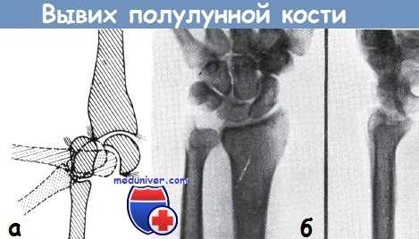 Вывих полулунной кости