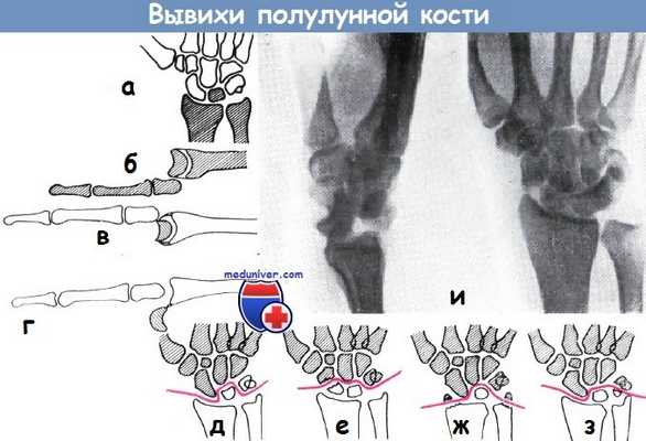 Вывихи полулунной кости