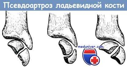 Псевдартроз ладьевидной кости