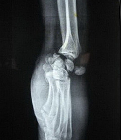 Рентгенограмма при перилунарном вывихе кисти