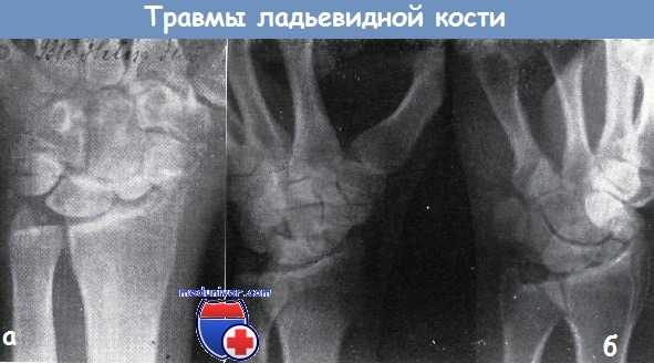 Травмы ладьевидной кости