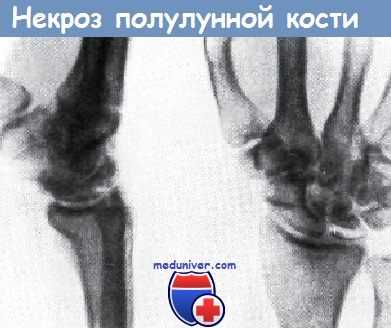 Некроз полулунной кости