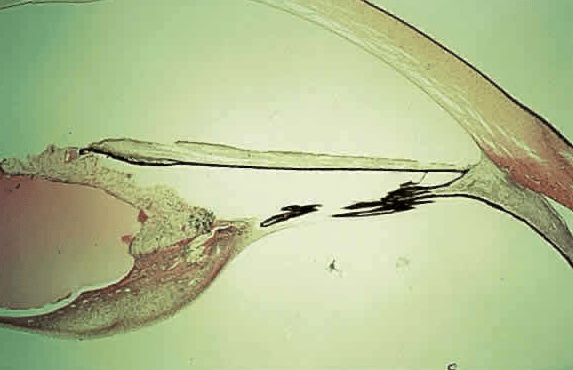 синдром персистирующего гиперпластического стекловидного тела, врожденная катаракта
