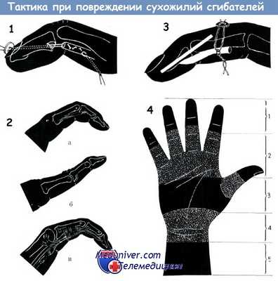 Тактика при повреждении сухожилий сгибателей пальцев кисти