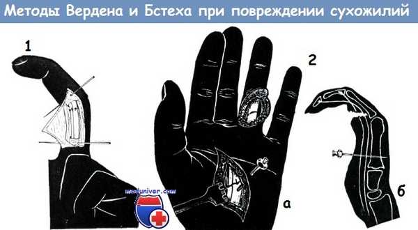 Методы Вердена и Бстеха при повреждении сухожилий сгибателей пальцев кисти
