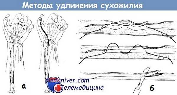 Методы удлинения сухожилия пальцев кисти
