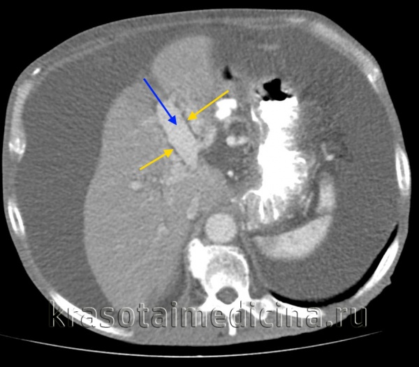 КТ ОБП. Этот же пациент, расширенный левый долевой ствол воротной вены (синяя стрелка) с периваскулярным отеком (желтая стрелка).
