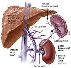 Сплено-ренальный шунт