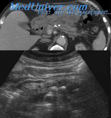 портальная гипертензия