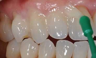 pokritiye zubov ftorlakom