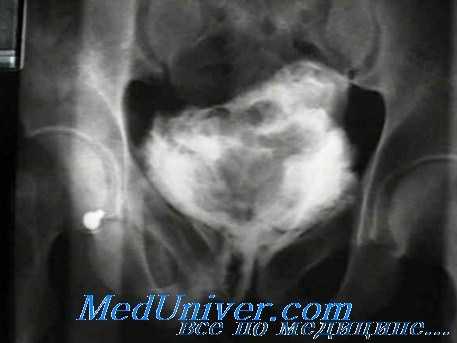 Цистография при травме мочевого пузыря