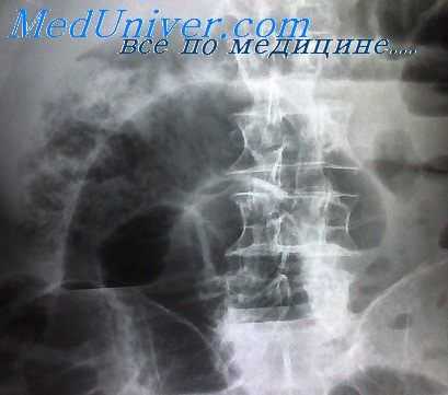 повреждения толстой кишки