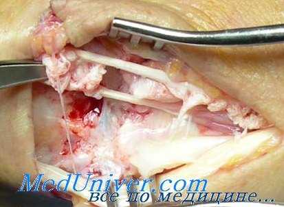 повреждения сухожилий кисти