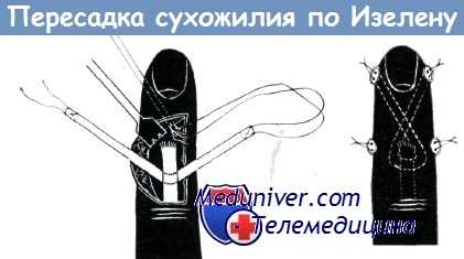 Пересадка сухожилия по Изелену
