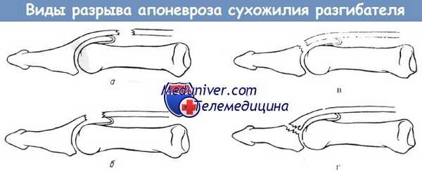 Виды разрыва апоневроза сухожилия разгибателя в пределах концевого сустава