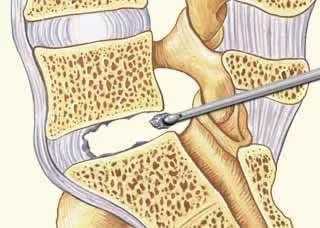 Микродискэктомия при люмбаго