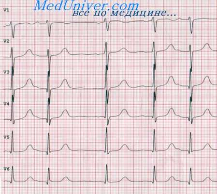 ЭКГ - предсердные экстрасистолы