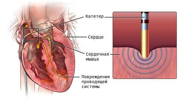 Радиочастотная катетерная абляция (РЧА)