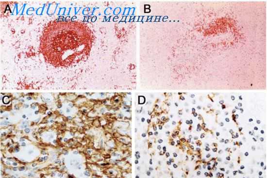 терапия сепсиса