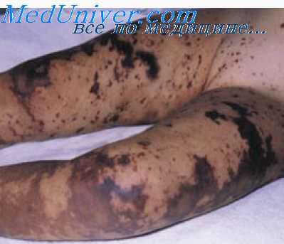 терапия сепсиса