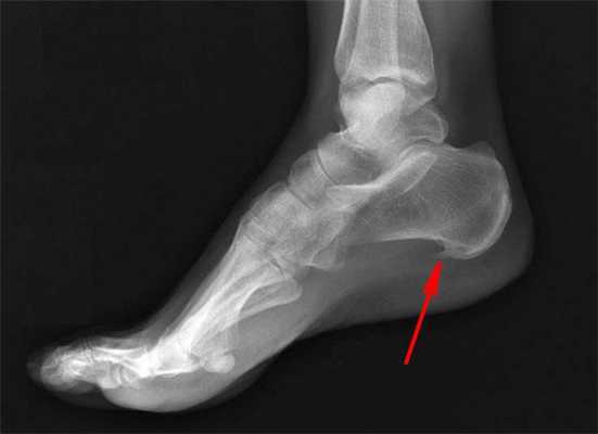 Пяточная шпора