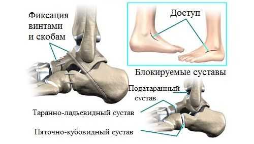 Артродезирование суставов стопы