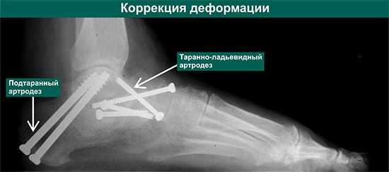 Подтараннй артродез