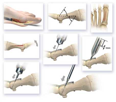 Остеотомия Scarf