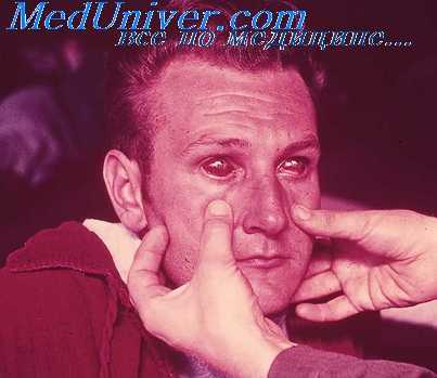 геморрагическая лихорадка