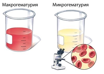 Макро- и микрогематурия
