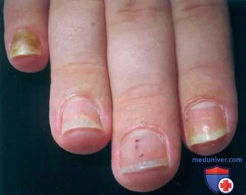 Псориаз ногтей