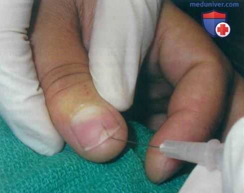 Псориаз ногтей