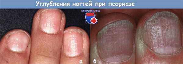 Углубления ногтей при псориазе