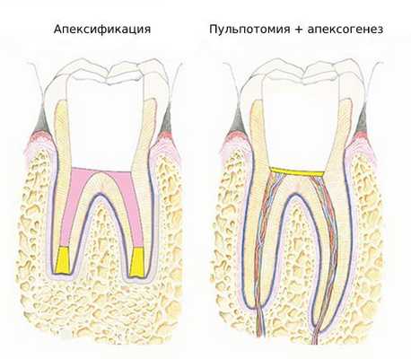 Апексификация и апексогенез 