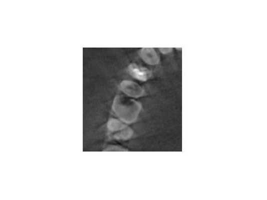 Снимок КТ до лечения (трансверсальная плоскость)