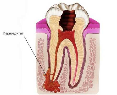 Периодонтит