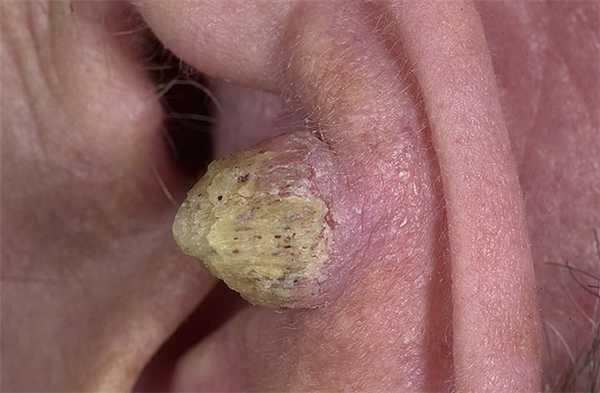 ПЛОСКОКЛЕТОЧНЫЙ РАК НАРУЖНОГО УХА.jpg