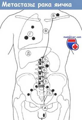 Метастазы рака яичка