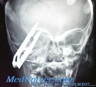 лечение ранений глазницы