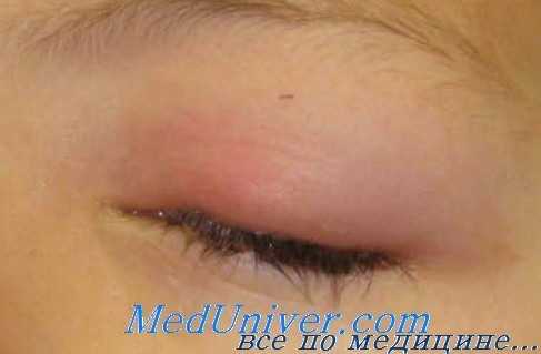 контузия глазницы