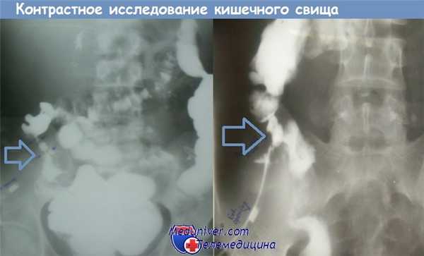 Контрастное исследование кишечного свища, сообщающегося с подвздошной кишкой
