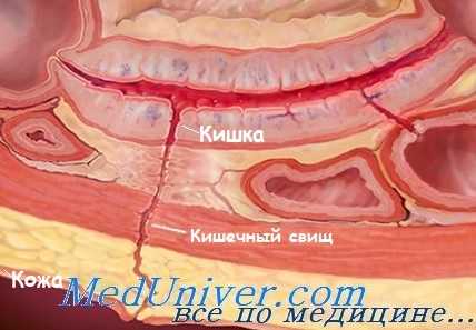 Кишечный свищ