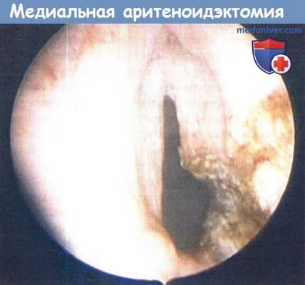 Медиальная аритеноидэктомия