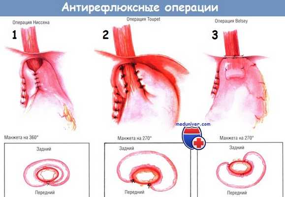Варианты антирефлюксных операций при ГЭРБ - фундопликация по Ниссену, Toupet, Belsey