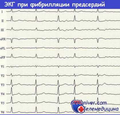 ЭКГ при фибрилляции предсердий