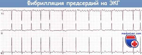 Фибрилляция предсердий на ЭКГ