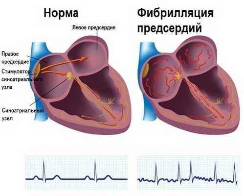 Фибрилляция предсердий на ЭКГ